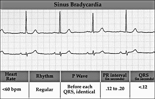 Bradycardia