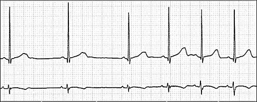 Sinusarrhythmia Sinusarrhythmia: szívfr. fiziológiásan emelkedik belégzés hatására (megemelkedett vénás beáramlás miatt). Kilégzésben a vagus-hatás nagyobb. Nem kóros.