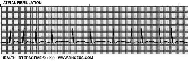 hullámot) és a QRS-ek szabálytalan (absolut arrhythmia) időközönként