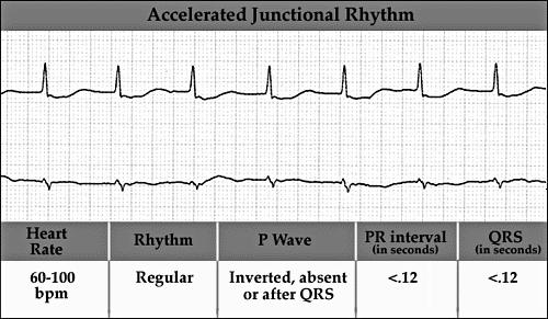 Accelerált junctionalis ritmus: egyes esetekben (AMI, digitális intoxicatio) az aktívvá vált heterotop