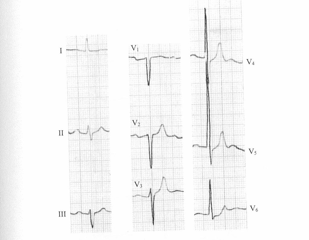 QRS komplexus Bal anterior hemiblokk Jellemzői: -Kóros bal tengelyállás -II, III avf-ben rs komplexus -I, avl-ben kis q hullámok -QRS nem szélesebb mint 120ms.