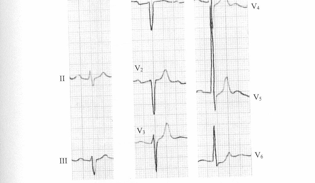 Jobb szárblokk QRS komplexus QRS kezdete normális (q hullám értékelhető mellette) infarktus felfedezhető (inferior, anterior).