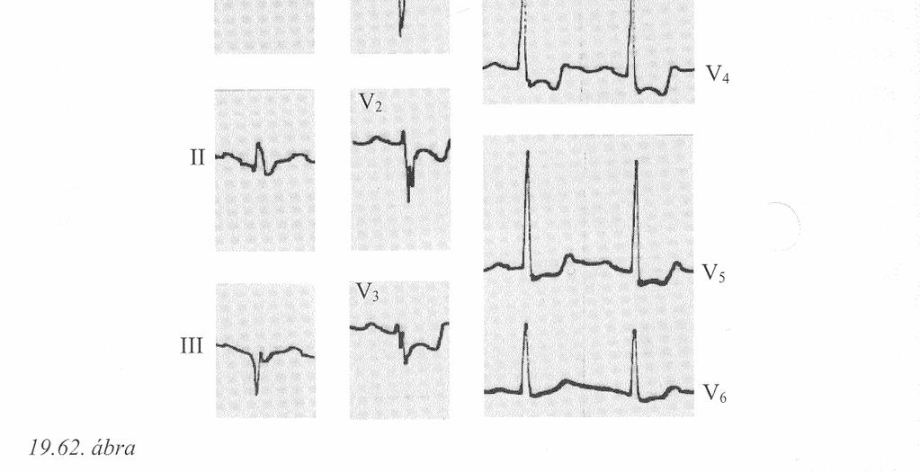 Angina 52