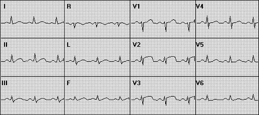 AMI Anterior