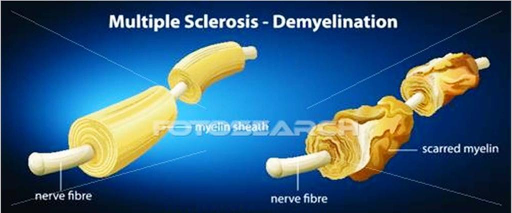 NEURITIS RETROBULBARIS diagnsztikája, differenciál diagnsztikája a legújabb neurimmunlógiai etipathmechizmus ismeretek és szisztémás kezelési ajánlásk