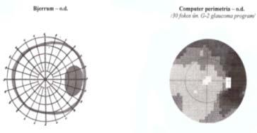 Single r Multiple Attacks f Optic Neuritis