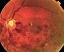 J f Neur-Ophthalmlgy 2012;32:102 106 1.