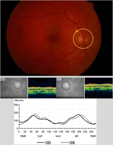 papilla rstveszteségének mérése - Heidelberg Retina Tmgráfia (HRT) -
