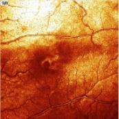 Mrflógiai eltérés mérése Kiegészítő vizsgálat Vizus (T, K)= krr=stly= kétldali: papilla edema egyldali: praethrmbsis színlátás AMSLER CFF NINCS Opticus léziók: