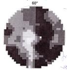 Szemtünetek NR Sclersis Multiplex -NR Neurmyelitis Optica -NMO Kezdeti tünetek Vizus Távli+Közeli Amsler Színlátás: CFF: Fundus Látótér VEP egyldali látásvesztés vakító