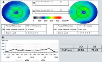 SM / NMO kzta neuritis retrbulbaris differenciál diagnsztikája etipathmechanizmus SM kzta Neuritis Retrbulbaris demyelinisati axnkársdás MS and NMO: Partners N Mre Steven L.