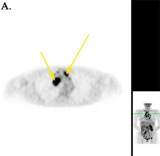 izotóp β + energia (MeV) β + hatótáv (mm) Τ felhasználás