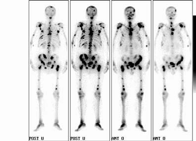 csontszcintigráfia Tc-MDP: 600 MBq A gamma-kamera időbeli és térbeli