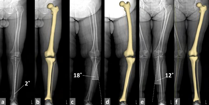11. Ábra Anterioposterior EOS 2D felvételek és alsó végtagi EOS térbeli rekonstrukciók frontális képe a térdízületi arthrosisos betegcsoport reprezentatív eseteiben (a-b) normál tengelyállás; (c-d)