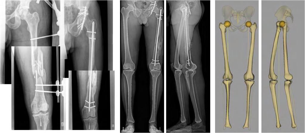 2 Az EOS 2D/3D vizsgálat alkalmazhatósága traumás alsó végtagi elváltozások posztoperatív elemzésére A vizsgált 30 alsó végtagi törés miatt oszteoszintézisen átesett beteg 60 végtagján kapott