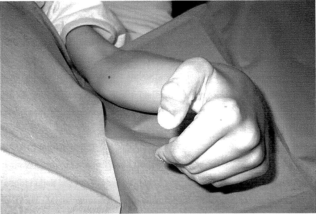 pronatiója is megfigyelhető, annak hátterében többnyire a m. extensor carpi ulnaris áll (7. ábra). Mindkét izmot általában a m.