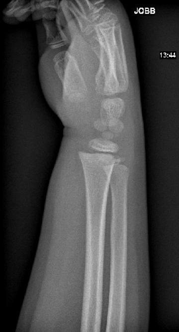 ábra alapján a radius distalis epiphysise 5 mm-t dorsal felé dislocalódott.