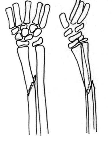 előfordul. Galeazzi-törésnek nevezik a radius diaphysisének törését, amely az ulna distalis harmadának subluxatiójával, luxatiójával vagy epiphyseolysisével jár együtt.