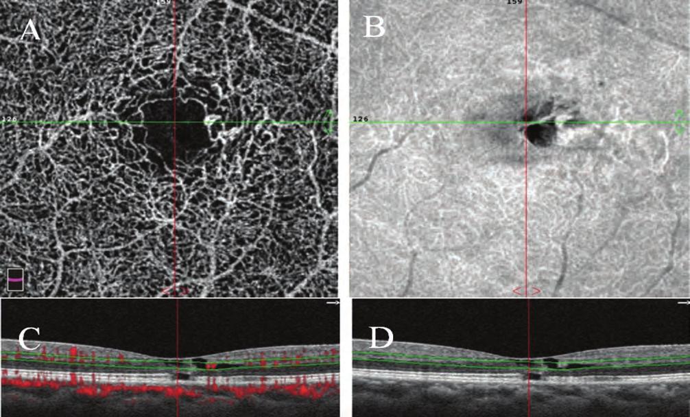 Significance of optical coherence tomography angiography 5. ábra: octa idiopátiás makula teleangiectasia kép.