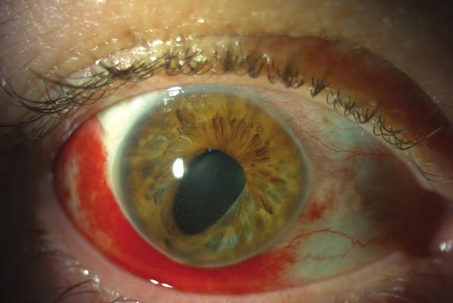 childhood uveitis 1. ábra: uveitis anterior dott leukocitáknak és fehérjéknek megfelelően precipitátum látható. Gyermekek esetében általában kisés középméretűek a precipitá tu - mok (1.
