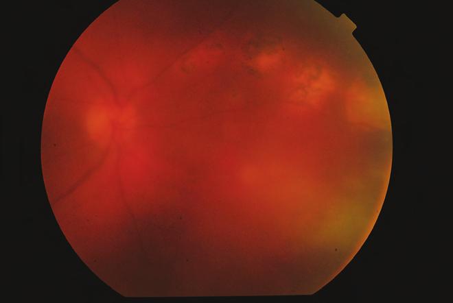 childhood uveitis laris lencse beültetésével (1, 47). A műtét során lensectomia-vitrec to - mia történik, hogy a krónikus uvei - tisért felelős antigén-stimulációt is csökkentsük.