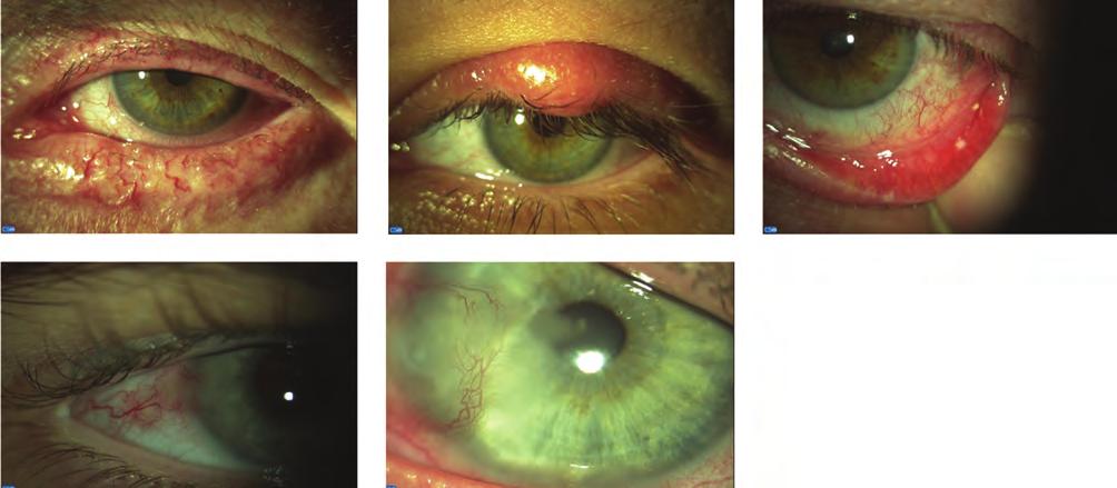 Severe form of ocular rosacea eltömeszelődését, kitágult Mei - bom-mirigyeket, habos megjelenésű alsó könnyfilm-meniscust egyaránt megfigyelhetünk. Jégárpa (1.