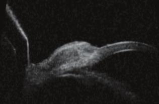 episcleritis, sclero-keratitis (1. E ábra), a legsúlyosabb esetekben scleromalacia, perifériás szaruhártya-perforáció formát ölthet (4, 7, 10).