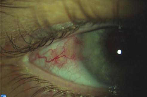 Súlyos ocularis rosacea 4. ábra (a-f) a beteg sclerocornealis elváltozásai 2011.
