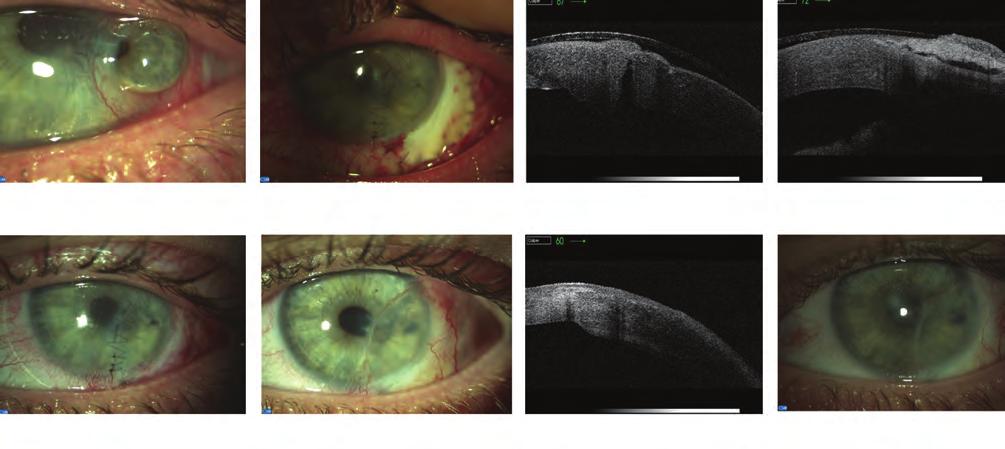 Severe form of ocular rosacea 5. ábra: bal szem spontán cornealis perforáció. műtéti megoldás: sclerokera - toplasztika (9 mm) 2013.10.17. spontán corneaperforáció 2013.10.18. posztoperatív 1.