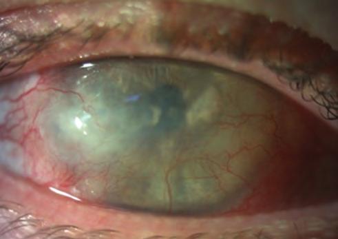 Súlyos ocularis rosacea 7. ábra: Jobb szem réslámpás képe utolsó megjelenéskor 8. ábra: bal szem réslámpás képe utolsó megjelenéskor nal minimális ereződése látható (8. ábra).