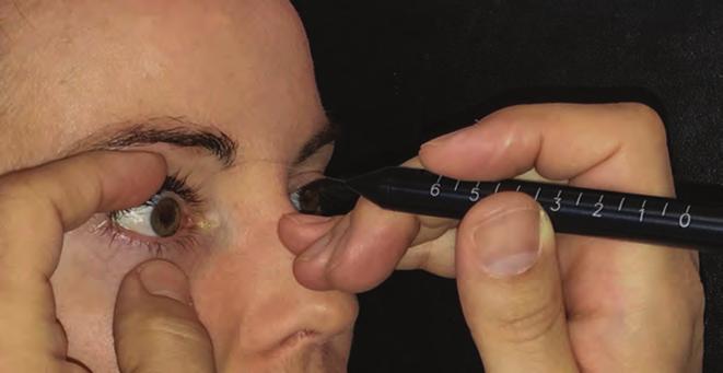 changes in corneal sensitivity following Bevezetés Az egyébként sikeres szürkehályogműtéteket követően is gyakori, akutan és krónikusan egyaránt jelentkező panasz a szem égő, törő, idegentest-érzése.