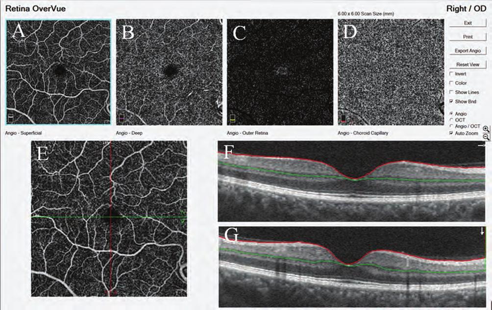 az optikai koherencia tomográfia angiográfia szerepe 1. ábra: octa szegmentációs rétegek. 55 éves férfi egészséges jobb szeme (6 6 mm; software rtvue Xr 100 avanti [optovue, Inc.fremont ca]).