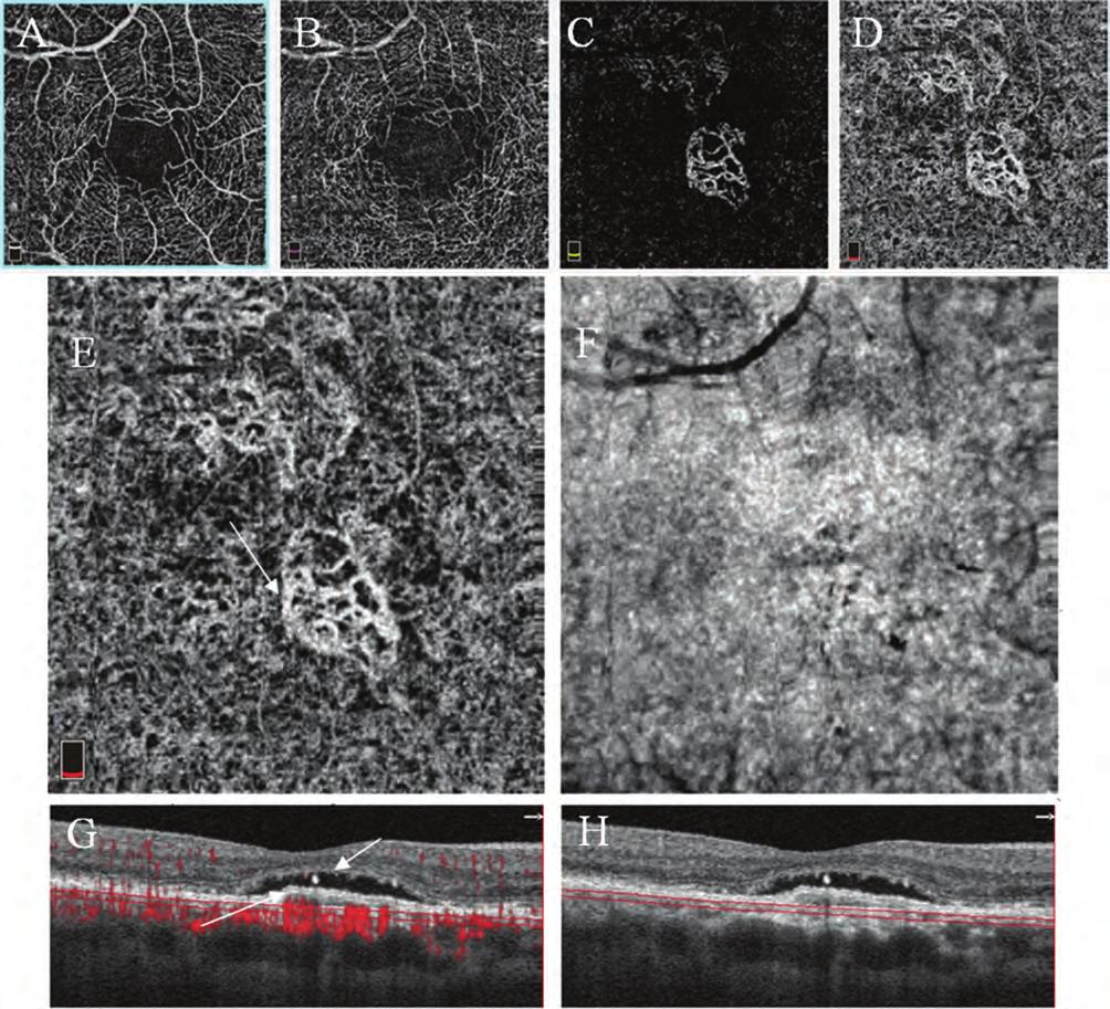 Significance of optical coherence tomography angiography 2. ábra: octa szegmentáiós rétegek, 72 éves férfi serosus makula dege - nerációs jobb szeme (3 3 mm).