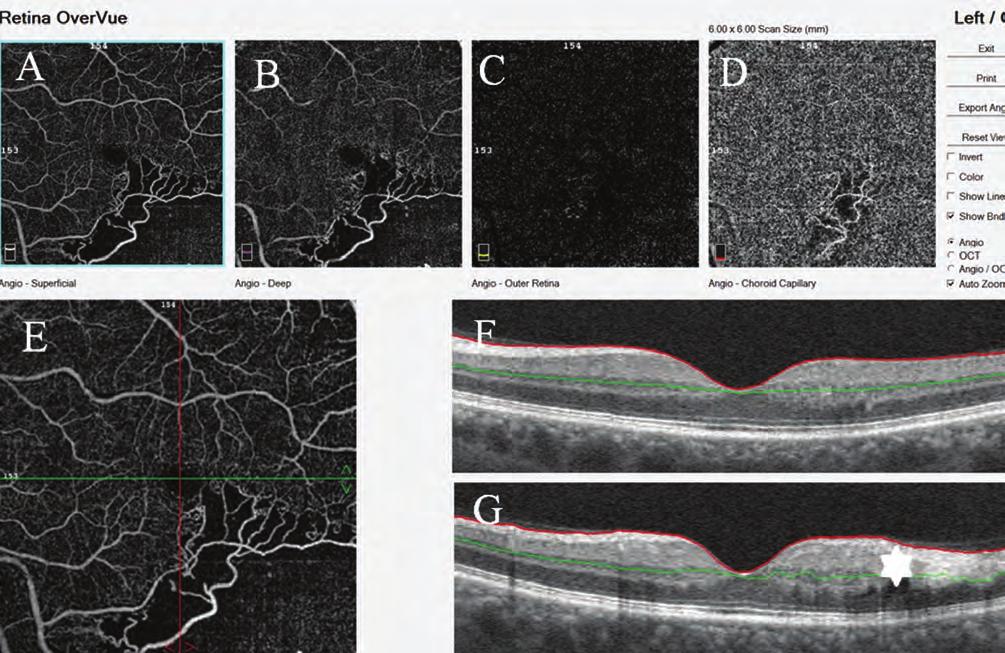 intraretinalis mic - roangiopathia), vékony nyíl mikroaneurizma, csillag neovaszkularizáció. b: en face mód. c: a mikrokeringés teljes hiánya, ún.