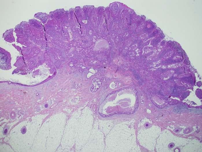 Apocrin carcinoma