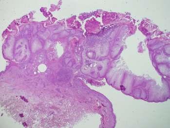 Sebaceus adenoma Arc, fej-nyak Idősebb