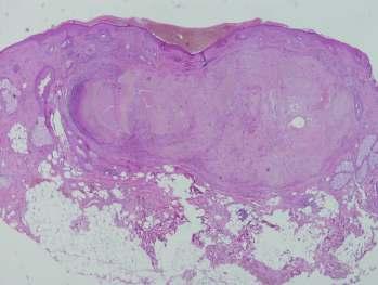 Pilomatrixoma Általában