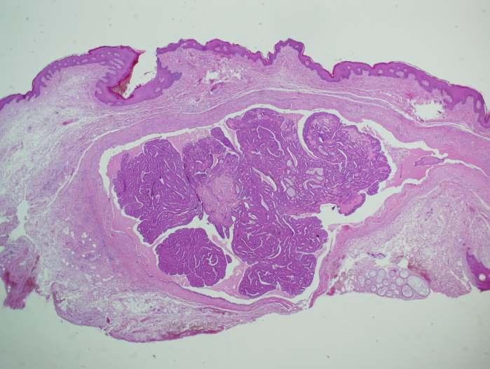 Hidradenoma papilliferum Gáttájékon, vulván,