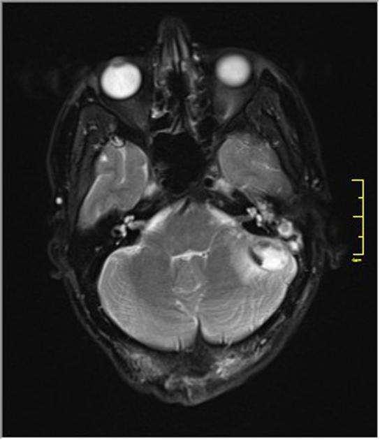 Mastoiditis,