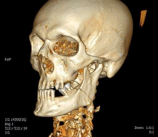 Mandibula törés 3D