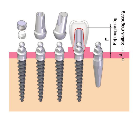 A CONEFIT lim Gömbfejű Implantátum Rendszer felépítményei A CONEFIT lim Gömbfejű Implantátum Rendszer alap rendeltetése, kivehető fogművek, rögzítése patentfelépítmény révén.