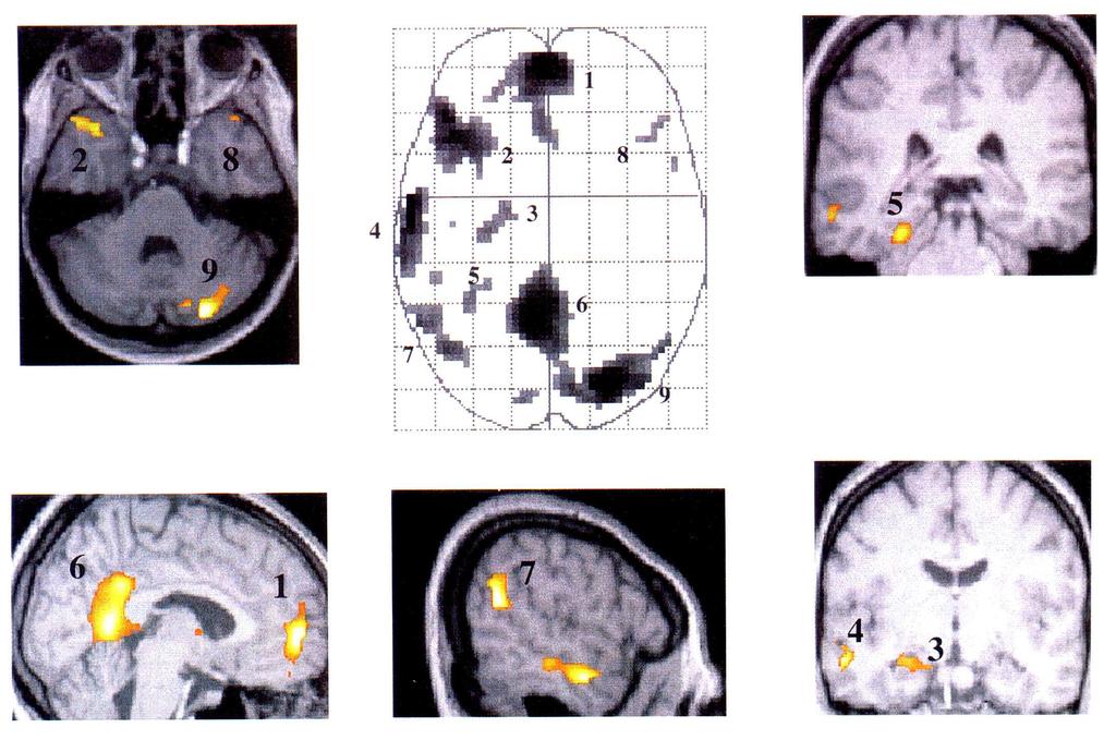 A hippokampusz szerepe a memóriában: képalkotás 1, medial frontal cortex; 2, left temporal pole; 3, left hippocampus; 4, left anterolateral middle temporal gyrus; 5,