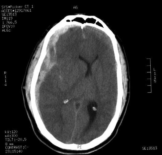 Traumához kapcsolódó fejfájások Alarmírozó jel: trauma az előzményben