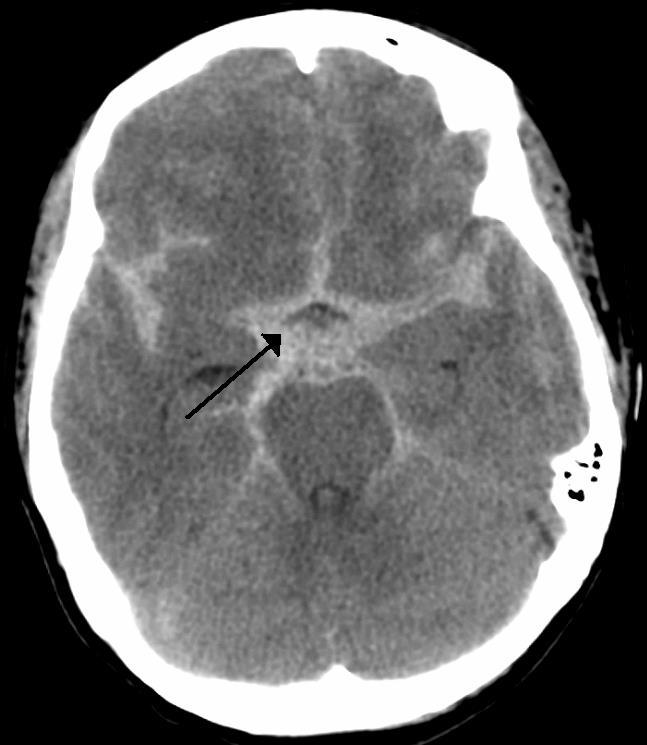 Subarachnoidealis vérzés Alarmírozó tünet : Hirtelen kezdetű, súlyos intenzitású Megsemmisítő erejű fejfájás Fejfájás jellegének megváltozása 90%-ban koponya CT-n hyperdens eltérés CT, MR