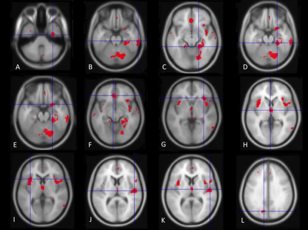 A depresszió neuroanatómiája: kiterjedt szürkeállománycsökkenés az érzelemszabályozásért felelős területeken Voxelalapú morfometriai vizsgálatok meta-analízise 472 beteg, 680