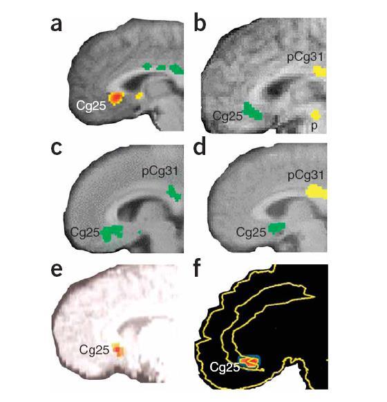 A medialis PFC (subgenu cingularis régió, Cg25) cortex szerepe az affektív regulációban a. Átmeneti szomorúság egészséges személyeknél b. Krónikus fluoxetin kezelés depresszióban c.