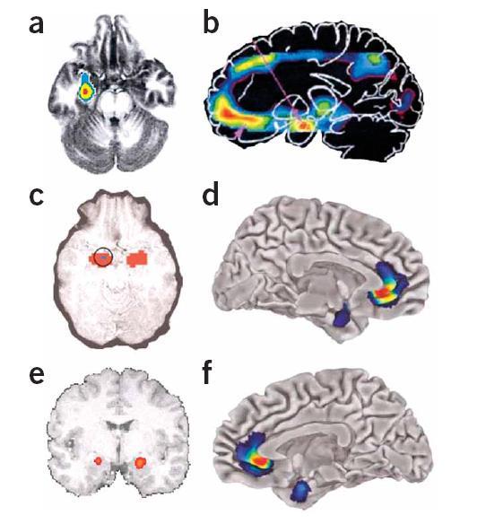 Az amygdala szerepe az affektív regulációban a. A citaloprmara vagy kognitív terápiára reagáló szociális fóbiában kifejezettebb amygdalaaktivitáscsökkenés b.