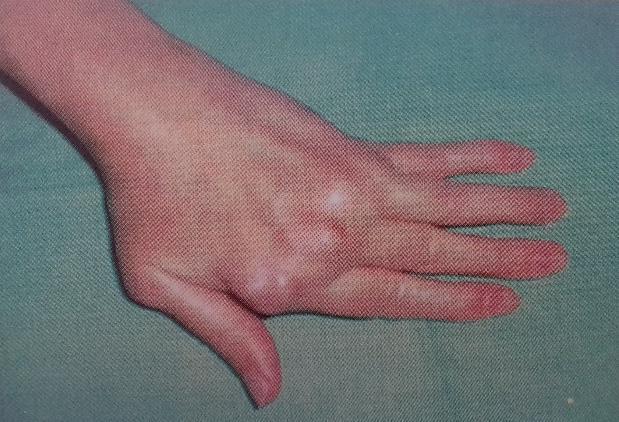 a kéz radiális ízületének ízületi gyulladása