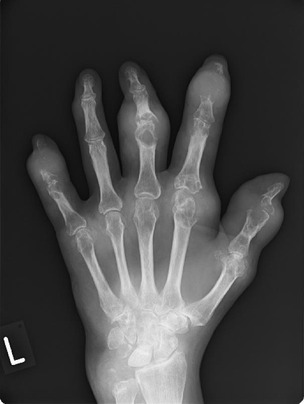 Trichinosis fájdalom a kezekben. Zsibbadás a kézben – az alagút szindróma tünetei