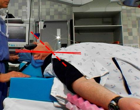 III. Előkészületek Optimalizálás avagy a sikeres első intubációs
